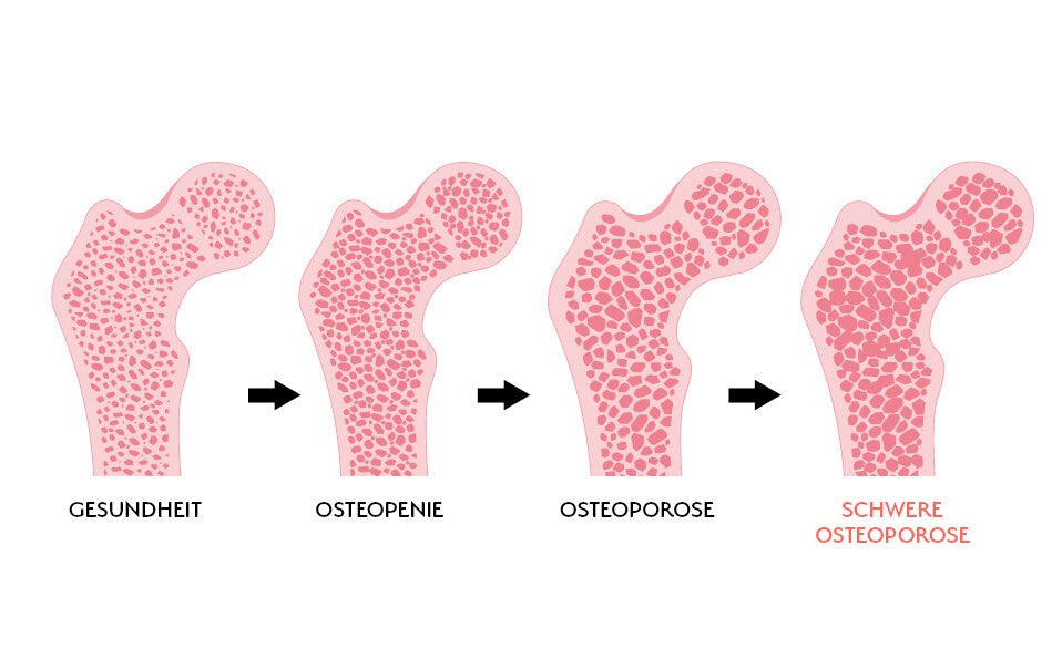 Wissenswertes zur Osteoporose