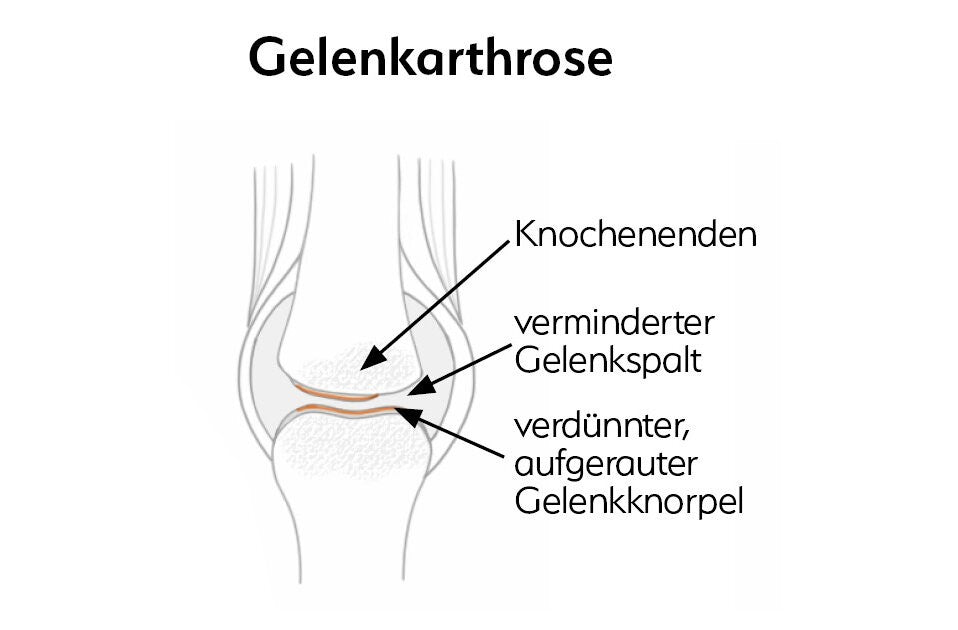 Was ist Arthrose wirklich?