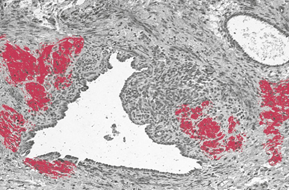 Was ist Endometriose?