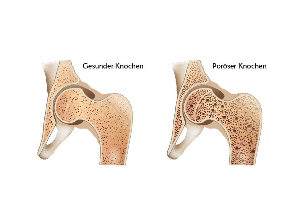 Osteoporose umfassend erklärt